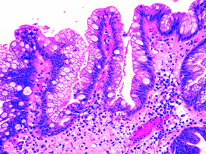 Pathology Outlines Barrett Esophagus Be